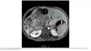 Hepatocellular Carcinoma Imaging [upl. by Eugirne]