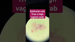 Its normal to have one to five squamous epithelial cells per high power field HPF in your urine [upl. by Bolen754]