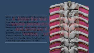 Landmark Based Thoracic Epidural [upl. by Nahpos]