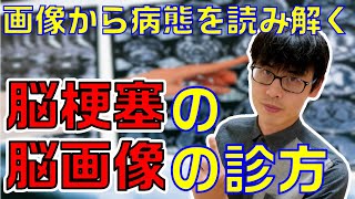 【脳梗塞の臨床症状の理解がグッと深まる！】脳梗塞の脳画像を診るポイントを解説します！ [upl. by Cohette]