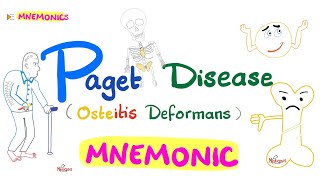 Paget Disease of Bone Osteitis Deformans  with a Mnemonic [upl. by Naiva]