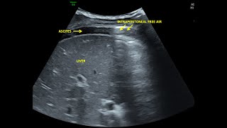 Perforation Peritonitis  Ultrasound [upl. by Amethyst]