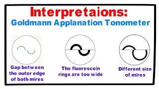 Interpretations Goldmann Applanation Tonometer [upl. by Andi]