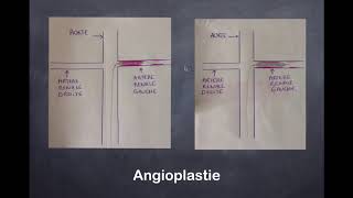 Sténose de lartère rénale  2 Radiologie Interventionnelle [upl. by Aicila]