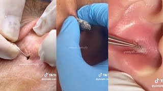 Ultimate ASMR Pimple Popping amp Blackhead Removal  Relaxation amp Satisfaction Guaranteed 🧖‍♀️ [upl. by Dionis]