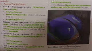 Keratoconjunctivitis Sicca  EYE [upl. by Oehsen]