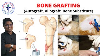 BONE GRAFTING  Lecture 05  Orthopedics [upl. by Bradstreet93]