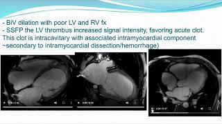 CAR  Case of the week  Case 6  Intramyocardial Dissection [upl. by Helfand]