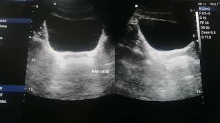 Normal Appearance of Urinary Bladder on Ultrasound and Calculating prevoid and Post  Void Volume [upl. by Rehpotsirhcnhoj]