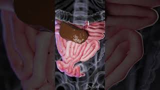 Understanding Small Bowel Perforation anatomy biology 3danimation [upl. by Hescock]