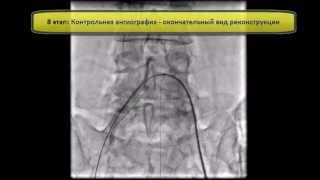 Реканализация и стентирование подвздошной артерии [upl. by Lohse]