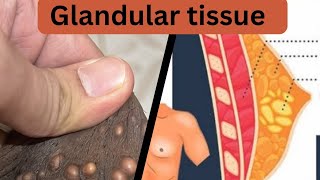 Nods glandular tissuedeath tissues Homeopathic medicineDr shaista [upl. by Hazard]