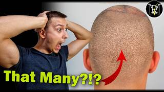 The Truth About Head Shaving After 2 Hair Transplants [upl. by Llorrac]