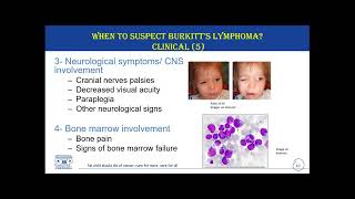 Diagnosis and Referral of Burkitt’s Lymphoma – 3 February 2023 [upl. by Ahsea636]