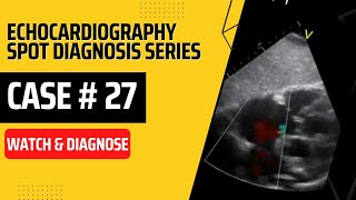 Case 27 Echocardiography Spot Diagnosis Case Series echocardiography echo cardiology case [upl. by Noremak]