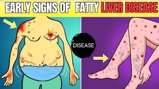 Early Signs of Fatty Liver Disease Recognize Symptoms Before Its Too Latequot [upl. by Ldnek]