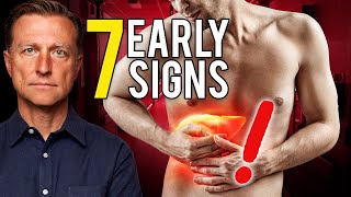 7 Early Signs of Liver Damage [upl. by Irej]