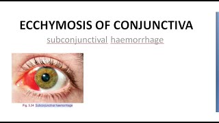 Ophthalmology Ecchymosis of Conjunctiva SubConjunctival Hemorrhage Blood red eye [upl. by Nail]