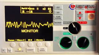 Fibrilación Ventricular [upl. by Cristian]