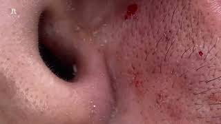 Big Cystic Acne Blackheads Extraction Blackheads amp Milia Whiteheads Removal Pimple Popping [upl. by Merl496]