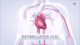 Einsetzen eines Defibrillators AICD Ausschnitt aus Volle Leistung für das Herz Teil 6 [upl. by Cattier]