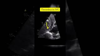 Subcostal View Showing Thrombus in IVC in a patient with Hepatocellular Carcinoma echocardiography [upl. by Orhtej388]