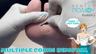 Corns Removal P1 feet κεντροποδιου foot podologos podiatrist corn footcare podiatry callus [upl. by Relyk]