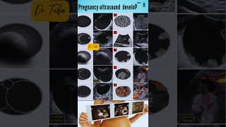 ultrasound in pregnancy development  fetal development scan baby ultrasound scan shorts [upl. by Augusta513]