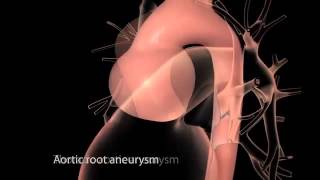 Aortic Disease Aortic Aneurysm and Dissection [upl. by Gabie]