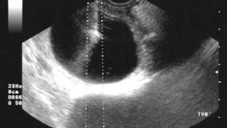 ovarian cyst drainage [upl. by Odlanar]