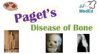 Paget’s Disease of Bone Osteitis Deformans  Causes Pathogenesis Symptoms Diagnosis amp Treatment [upl. by Aihsened]