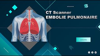 CT Scanner EMBOLIE PULMONAIRE  Partage de pratiques [upl. by Aivuy]