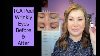 TCA Peel for Eyelids  Before amp After Demo  WrinklyMature Eyes [upl. by Nylemaj]