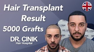 Hair Transplant Results with 5000 Grafts  Before and After  Dr Emrah Cinik [upl. by Hilel]