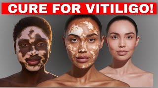 Vitiligo Skin Disease Treatment CausesTreatments  Home Remedies to cure Vitiligo Fast [upl. by Gurl]