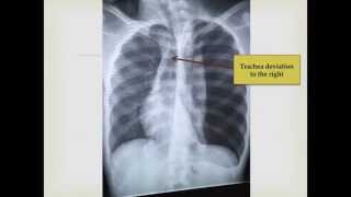 Spontaneous Tension Pneumothorax CXR Bilateral sides [upl. by Kenley]