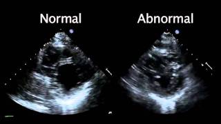 Echocardiogram from the Patient Compared with That from a Normal Control  NEJM [upl. by Asiil]