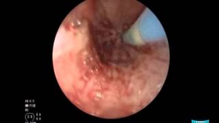 Iatrogenic Perforation of an Advanced Esophageal Carcinoma Placement SelfExpanding Metal Stent [upl. by Ilsa383]