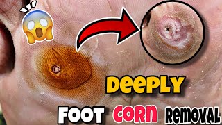 foot huge corn  carefully and safely removed callus [upl. by Dewayne110]