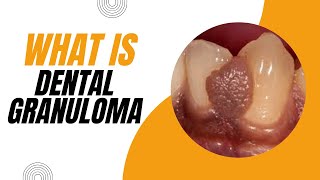 What is Dental Granuloma Causes Symptoms and Treatment [upl. by Enimsay416]