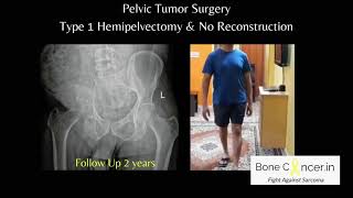 Treatment for Bone Cancer Chondrosarcoma Pelvic Tumour SurgeryHemipelvectomy Dr Srimanth B S [upl. by Llebanna220]