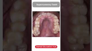 Supernumerary Teeth  Paramolar [upl. by Adyol]