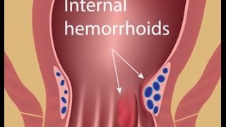 Hemorrhoid Treatment with Colorectal Surgeon Dr Jennifer Lowney [upl. by Ludly]