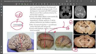 5 Lissencephaly [upl. by Wons645]