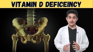 Osteomalacia 3d animation  Vitamin D function deficiency  cause symptoms  pathophysiology  hindi [upl. by Nelle989]