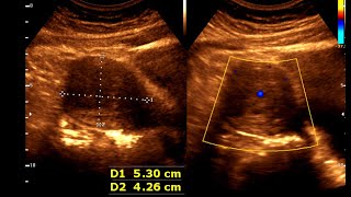 Endometriosis  Chocolate Cyst [upl. by Leind110]