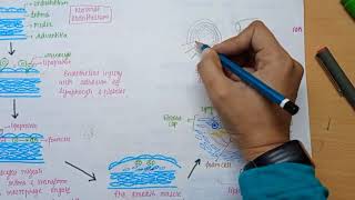 Atherosclerosis  Cause  pathology  Coronary Artery Disease in Hindi [upl. by Pierce292]