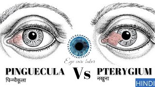 आँख में पीले धब्बे । Yellow spot in eye । how to cure from yellow eye  Pterygium and Pinguecula [upl. by Annawit]