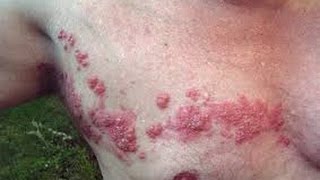 What is Shingles [upl. by Pavkovic45]