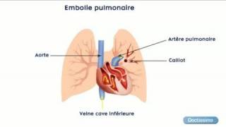 Zoom sur les maladies thromboemboliques veineuses [upl. by Viki]